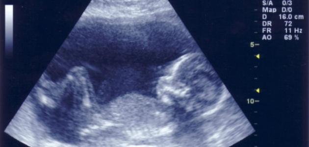 صورة جديد طرق معرفة نوع الجنين في الشهر الأول