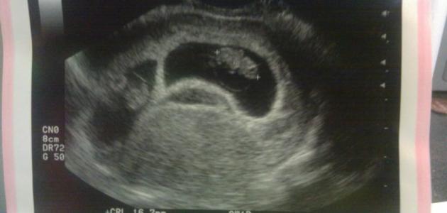 صورة جديد متى يظهر كيس الحمل بالرحم