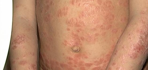 صورة جديد أنواع الأمراض الجلدية
