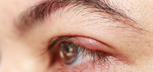 صورة جديد كيفية علاج شحاذ العين
