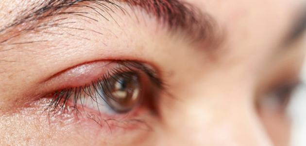 صورة جديد علاج التهاب حول العين