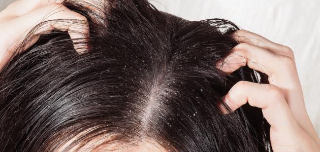 604217b6ba012 جديد طريقة التخلص من قشرة الشعر