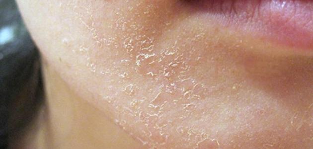 صورة جديد كيفية علاج جفاف الوجه