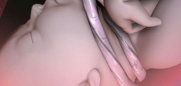 صورة جديد ما هي أسباب إلتفاف الحبل السري على الجنين