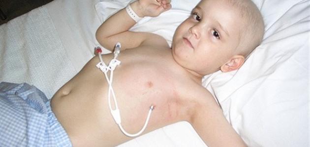 صورة جديد أعراض سرطان الدم عند الأطفال