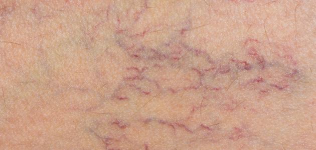 صورة جديد ظهور الشعيرات الدموية على سطح الجلد