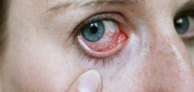 صورة جديد أعراض مرض شبكية العين