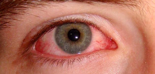 صورة جديد أمراض العين وكيفية الوقاية منها
