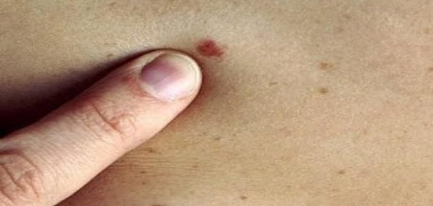 صورة جديد كيف يبدأ سرطان الجلد