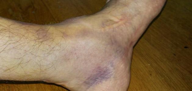 صورة جديد كيفية علاج كدمات القدم