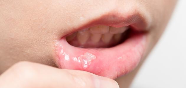 6049c3ccd6811 جديد ما هي أعراض فطريات الفم