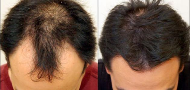 صورة جديد علاج تساقط الشعر والصلع