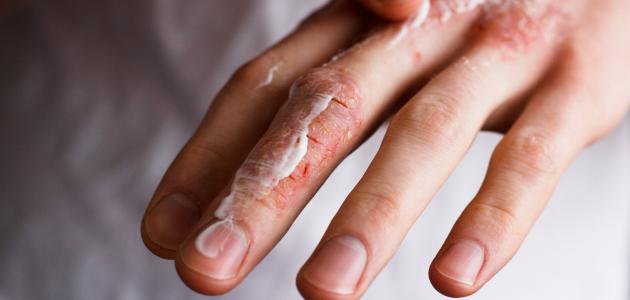 صورة جديد أنواع حساسية الجلد