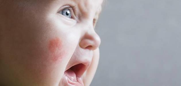 صورة جديد أسباب ظهور حساسية الجلد عند الأطفال