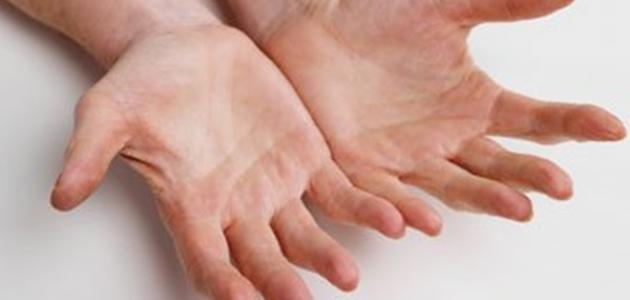 صورة جديد كيفية علاج تعرق اليدين والرجلين