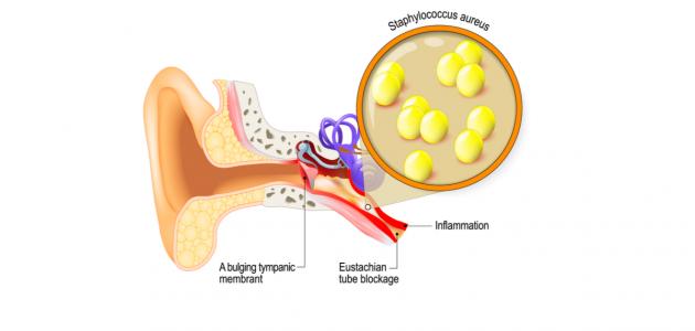 صورة جديد أسباب التهاب الأذن الوسطى