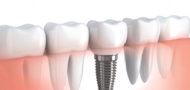 صورة جديد الفرق بين زراعة الأسنان وتركيب الأسنان