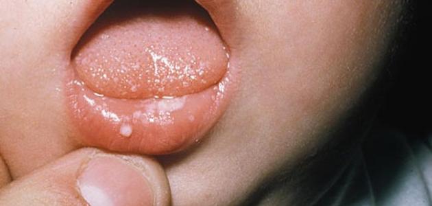 صورة جديد فطريات الفم عند الرضع أسبابها وعلاجها