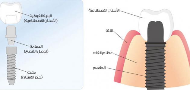 صورة جديد مراحل زراعة الأسنان