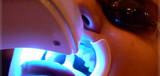 60523ab53c730 جديد كيفية تبييض الأسنان بالليزر