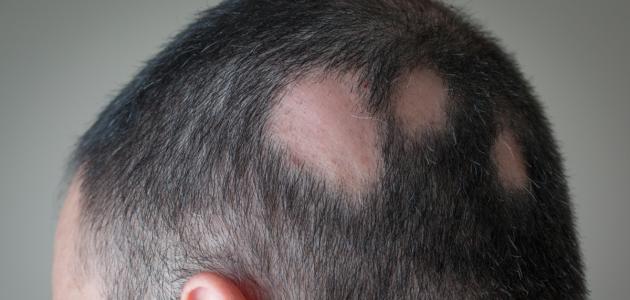 صورة جديد أعراض ثعلبة الشعر