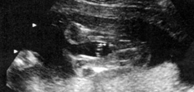 صورة جديد كيف أعرف بالسونار جنس الجنين