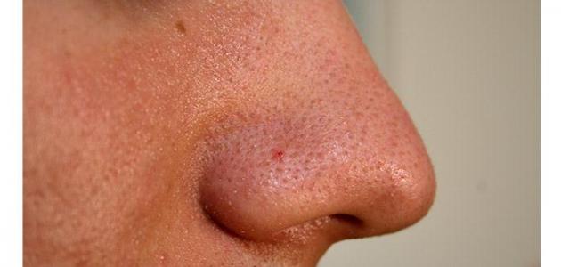 صورة جديد كيفية علاج مسامات الوجه