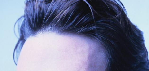 صورة جديد علاج تساقط الشعر من مقدمة الرأس