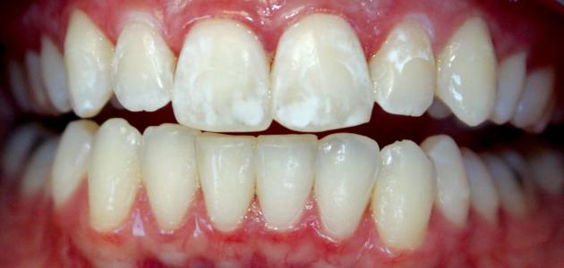 6058a2709c598 جديد البقع البيضاء في الأسنان