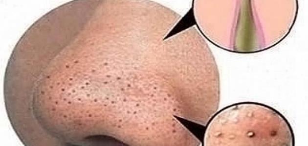 صورة جديد كيف أزيل البقع السوداء من الوجه