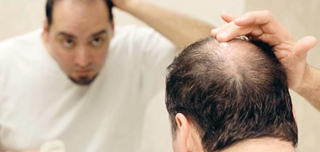 صورة جديد تساقط الشعر عند الرجال