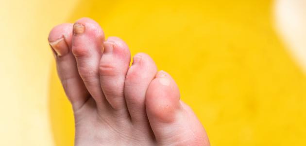 صورة جديد كيفية علاج تورم أصبع القدم الكبير