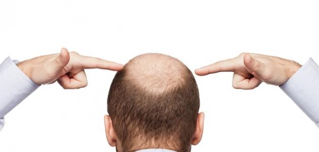 صورة جديد طرق معالجة تساقط الشعر عند الرجال