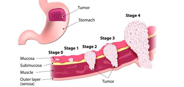 صورة جديد سرطان المعدة وأعراضه