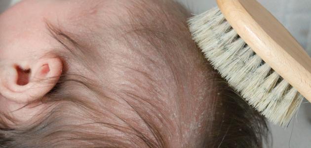 صورة جديد كيفية التخلص من قشرة شعر الرضيع