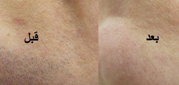 606f50848515e جديد علاج ظهور الشعر الزائد في الوجه