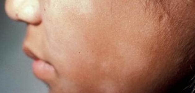 صورة جديد علاج الفطريات في الوجه