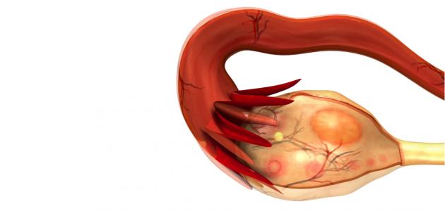 صورة جديد اسباب تكيس المبايض وعلاجه
