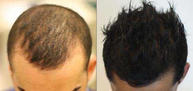 صورة جديد كيف تتم عملية زراعة الشعر