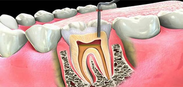 صورة علاج التهاب عصب الأسنان