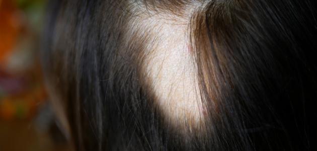 صورة ما هو علاج ثعلبة الشعر