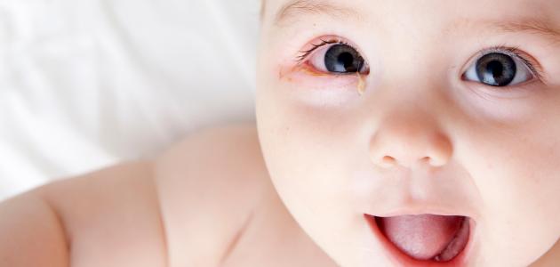 صورة التهاب عين الطفل