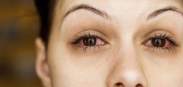 607b51a569161 أعراض التهاب الملتحمة في العين