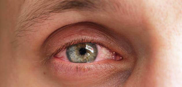 صورة ما هو علاج رمد العين