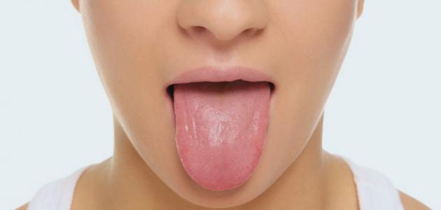 صورة علاج الفطريات في الفم واللسان