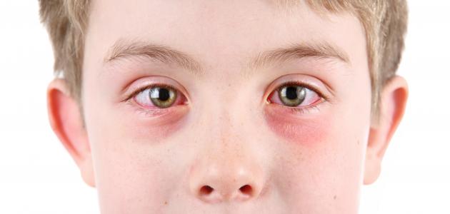 صورة التهاب ملتحمة العين عند الأطفال