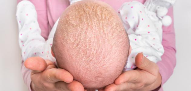 صورة أنواع قشرة الشعر عند الأطفال