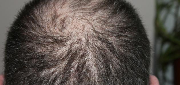 صورة ما سبب تساقط الشعر عند الرجال