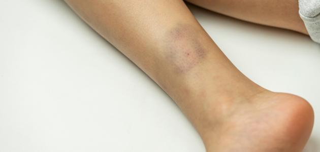 صورة أسباب كدمات الساق عند الأطفال