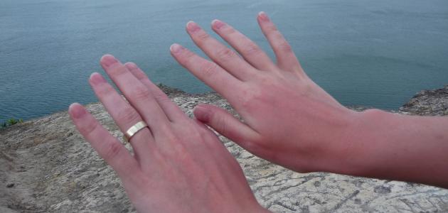 صورة آثار الشمس على اليدين